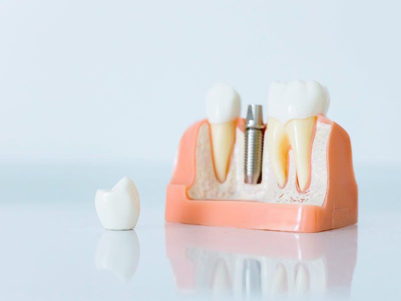 Endodoncia con Rafael González Odontólogos Endodoncia con Rafael González Odontólogos