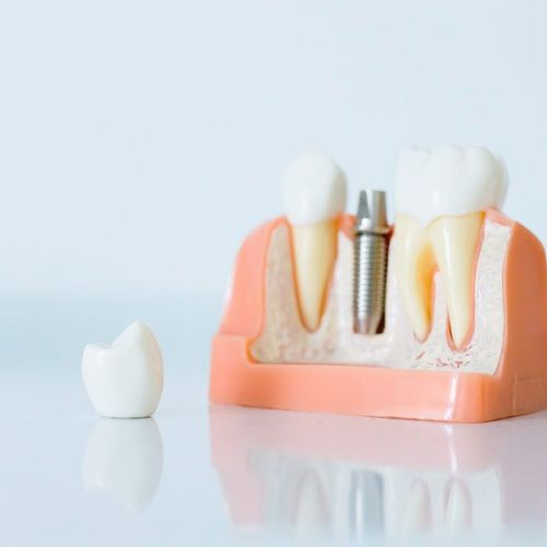 Endodoncia con Rafael González Odontólogos Endodoncia con Rafael González Odontólogos